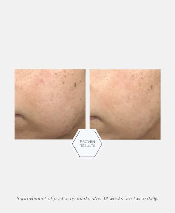 Neostrata Post-Acne Correcting Serum 30ml - Bild 7